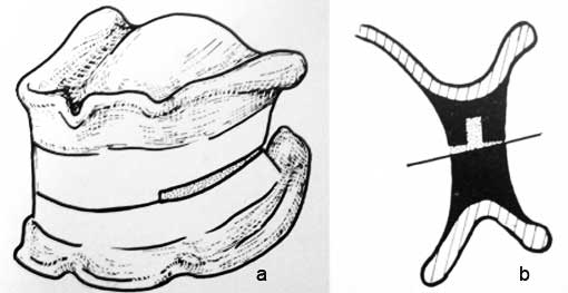 Fig. 2  : Enregistrement de la courbe individuelle d’occlusion (1) 