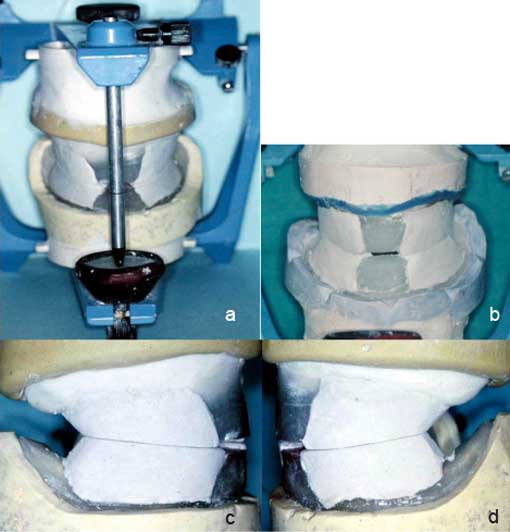 Fig. 8 : Confection des bourrelets abrasifs sur articulateur : butée antérieure en résine repère de la DVO préétablie et bourrelets postérieurs abrasifs : a- vue globale. b- vue antérieure. c- vue latérale droite. d- vue latérale gauche