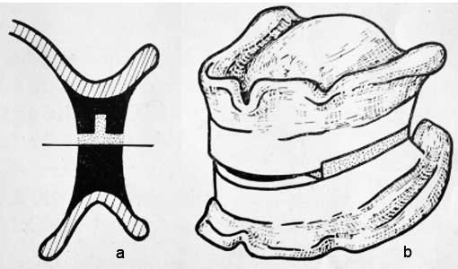 Fig. 1 : Confection de bourrelets spécifiques (1) : a- Canelure rétentive crée sur la surface occlusale du bourrelet fixant le mélange abrasif. b- Surélévation des bourrelets 