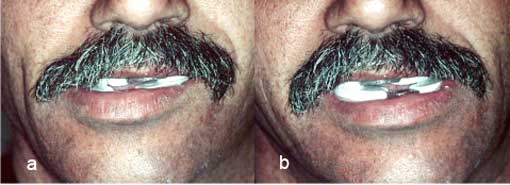 Fig. 10 : Enregistrement dynamique : a- mouvement de latéralité droite. b- mouvement de latéralité gauche Fig. 10 : Enregistrement dynamique : a- mouvement de latéralité droite. b- mouvement de latéralité gauche