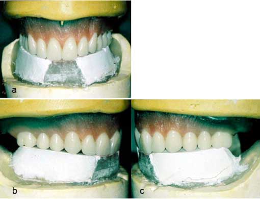 Fig. 13 : Montage des dents maxillaires sur la courbe individuelle d’occlusion mandibulaire. a- vue antérieure. b- vue latérale droite. c- vue latérale gauche