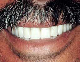 Fig. 16 : Insertion en bouche de la prothèse. Fig. 16 : Insertion en bouche de la prothèse.