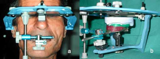 Fig. 6 : a - Enregistrement de l’arc facial. b - Transfert du modèle maxillaire sur articulateur à l’aide de l’arc facial.