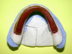 fig. 11 : PEI mandibulaire sur modèle fractionné.