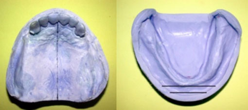 fig. 17 : Modèles secondaires maxillaire et mandibulaire.