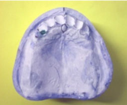 fig. 33 : Rectification du modèle : suppression des dents.
