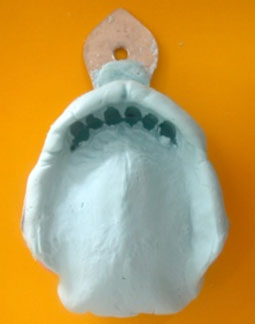 fig. 6 : Empreinte primaire maxillaire à l’alginate.