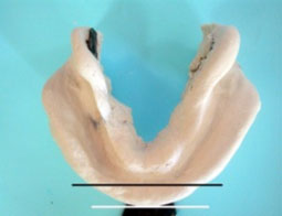 fig. 7 : Empreinte primaire mandibulaire au plâtre.