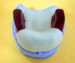 fig. 8 : PEI maxillaire.