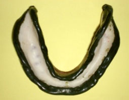 fig. 15 : Remarginage à la pâte de Kerr verte avec un bord antérieur épais. fig. 15 : Remarginage à la pâte de Kerr verte avec un bord antérieur épais.