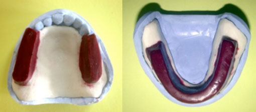 fig. 18 : Maquettes d’occlusion maxillaire et mandibulaire.