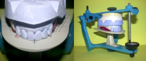 fig. 20 : Transfert du modèle maxillaire sur articulateur à l’aide du plateau de montage.