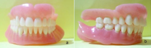 fig. 40 : Prothèses définitives : a- vue de face, b- vue de profil.