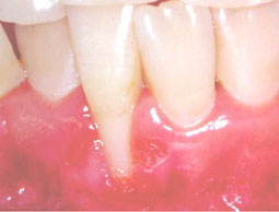 Fig. 3b : Récession gingivale de classe III de Miller (1985) avec destruction marginale du support  interdentaire