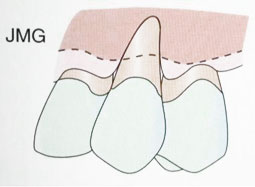 Fig. 4a : Récession gingivale de classe IV (Sato 2000).