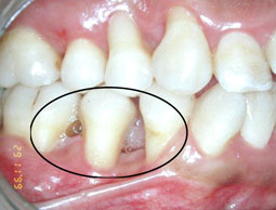 Fig. 4b : Récession gingivale de classe IV de Miller 1985. On note la perte importante du support parodontal, la traction freinale ainsi que des migrations dentaires.