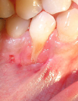 Fig. 5a : Récession gingivale avec absence totale de gencive kératinisée : on note l’inflammation marquée.