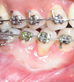Fig. 5b : Une greffe épithélio-conjonctive est réalisée avant le traitement orthodontique : la cicatrisation à 15 mois montre la création d’une bande de gencive kératinisée. Le recouvrement reste partiel du fait de l’importance de la récession initiale.