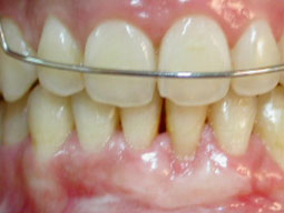 Fig. 6b : Une freinectomie a été réalisée associée à une greffe épithélio-conjonctive : cicatrisation à 18 mois après traitement orthodontique.