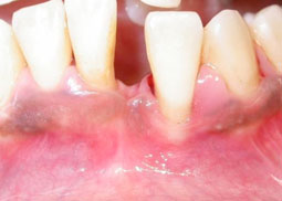 Fig. 7a : Récession gingivale de classe III associée à une parodontite agressive. On note une destruction tissulaire interproximale ainsi qu’une vestibuloposition de la dent.