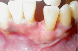 Fig. 7b : Une greffe gingivale libre a été réalisée après thérapeutique étiologique. On note un recouvrement partiel du fait de l’insuffisance des tissus inter proximaux et de la vestibuloversion de la dent.