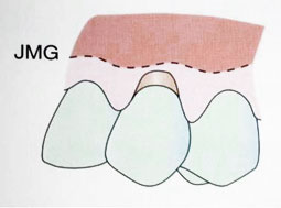 Fig. 3a : Récession gingivale de classe III (Sato 2000).