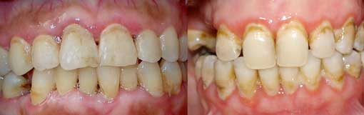 Fig.3 : Erythème gingival linéaire (Service de parodontologie CCTD Casablanca)