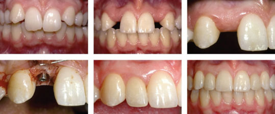 M.K. Kokich, V.G. Kokich Effective teaching the art of engagement Part 1 and 2.Journal of Orthodontics, vol 33, 2006, 126