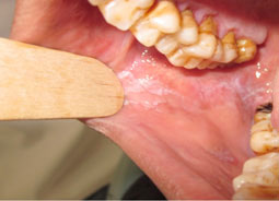 Fig.1 : Lichen plan de la face interne de la joue en forme de stries