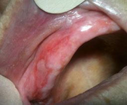 Fig.2 : Lichen plan érosif au niveau de la crête maxillaire édentée