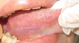 Fig.3 : Lichen plan atrophique au niveau du bord latéral de la langue