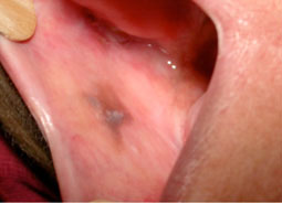 Fig.5 : Lichen plan nigricans sur la face interne de la joue