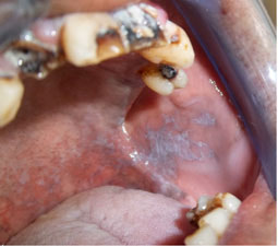 Fig.6 : Leucoplasie tabagique sur la face interne de la joue Fig.6 : Leucoplasie tabagique sur la face interne de la joue