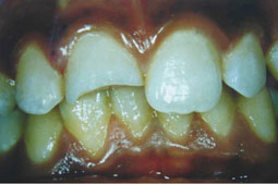 Fig.10: Fracture coronaire simple de la 11 