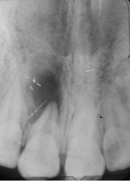 Fig.13 : radiogramme montrant une racine avec un canal large, un apex immature et une radioclarté apicale sur la 11.