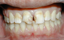 Fig.1a : composites infiltrés en mésial des 11 et 21, perte du composite distal et au niveau du bord libre de la 11.