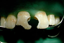 Fig.4a : aspect blanc crayeux obtenu après mordançage acide.