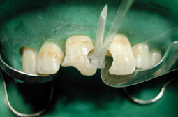 Fig.5a : matrice celluloïde et coin en plastique.