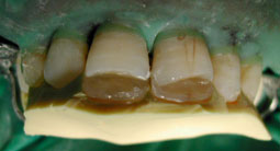 Fig.9a : La clé repositionnée en palatin sert de support à la couche de composite émail palatin: Mise en place de la coque d’émail qui est translucide.