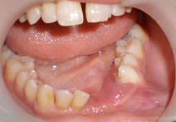 Fig.3 : Vue endobuccal  montrant une tuméfaction parasymphysaire gauche avec comblement vestibulaire inférieur gauche.