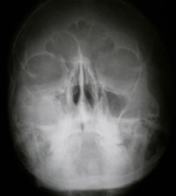 Fig.4 : incidence blondeau objectivant une opacité du sinus maxillaire droit.
