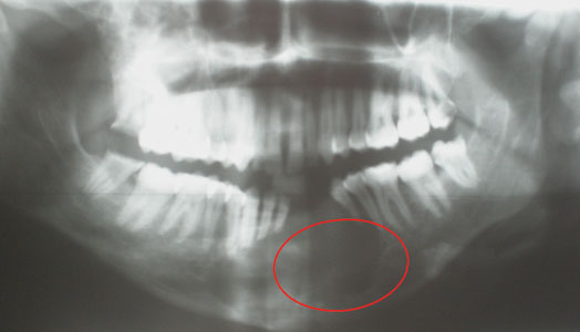 Fig.5 : Radio panoramique montrant une lacune osseuse mandibulaire bien limitée.