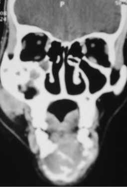 Fig.7 : TDM mandibulaire en coupe axiale: masse au niveau de la région symphysaire et parasymphysaire.