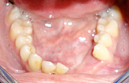 Fig.8 : Vue endobuccale 2 mois après l’intervention : réduction de la masse de la tuméfaction parasymphysaire gauche.