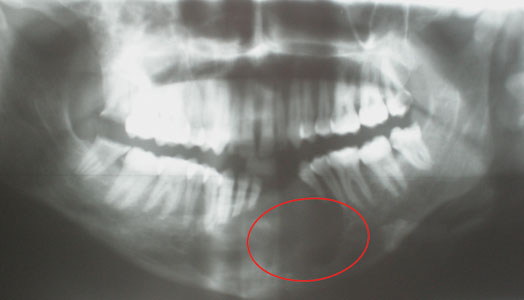 Fig.5 : Radio panoramique montrant une lacune osseuse mandibulaire bien limitée. Fig.5 : Radio panoramique montrant une lacune osseuse mandibulaire bien limitée.