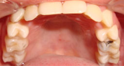 Fig.2 : 65 : Présence d’une carie amélo-dentinaire avec effondrement de crête et mobilité degré 3,  55 : Mobilité degré 3