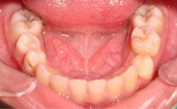 Fig.3 : 75 : Carie amélodentinaire avec mobilité degré 3  36/ 46 : Des caries amélo - dentinaires