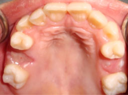 Fig.5 : Mise en état de la cavité buccale (Vue maxillaire).