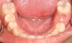 Fig.6 : Mise en état de la cavité buccale (Vue mandibulaire).