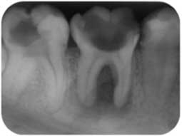 Fig 1a : Parodontite apicale chronique en regard de la 46. Noter le grand délabrement très important de la couronne dentaire.